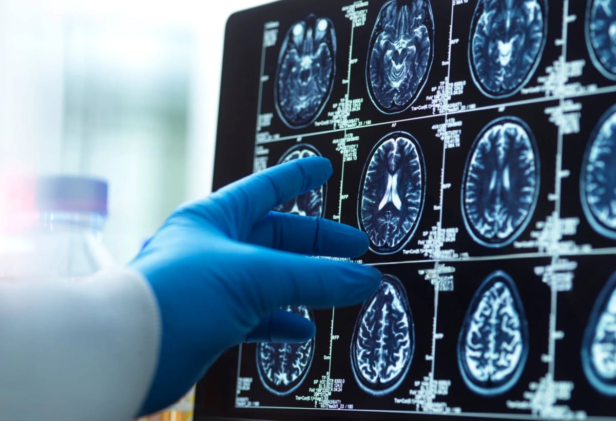 A doctor's hand pointing at a brain scan on a computer screen